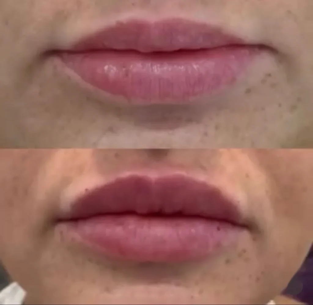 Before and after photos showing a subtle increase in lip volume.